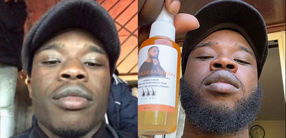 3 ACTIVATEURS DE POUSSE + ROLLER OFFERT - LA CURE DE 3 MOIS POUR UN DEBUT DE BARBE™