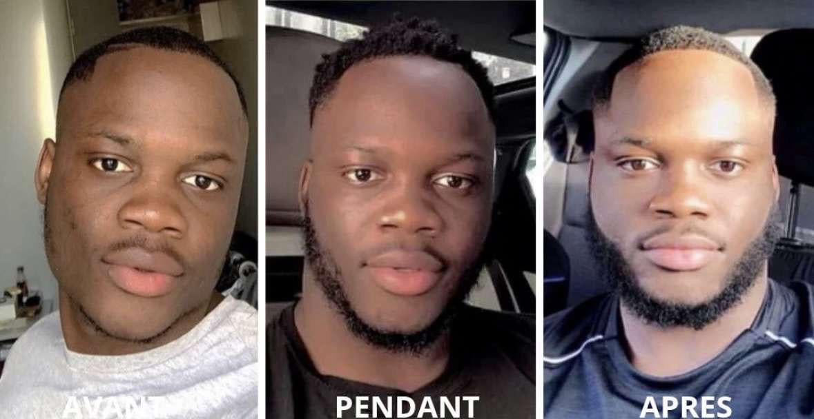 2 ACTIVATEUR DE POUSSE + ROLLER OFFERT - CURE 2 MOIS